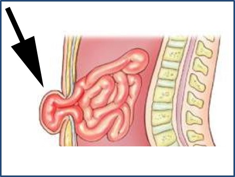 Recuperação da cirurgia de hérnia umbilical é simples - SBH