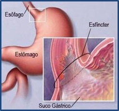 Hérnia inguinal nos praticantes de musculação - Hernia Clinic