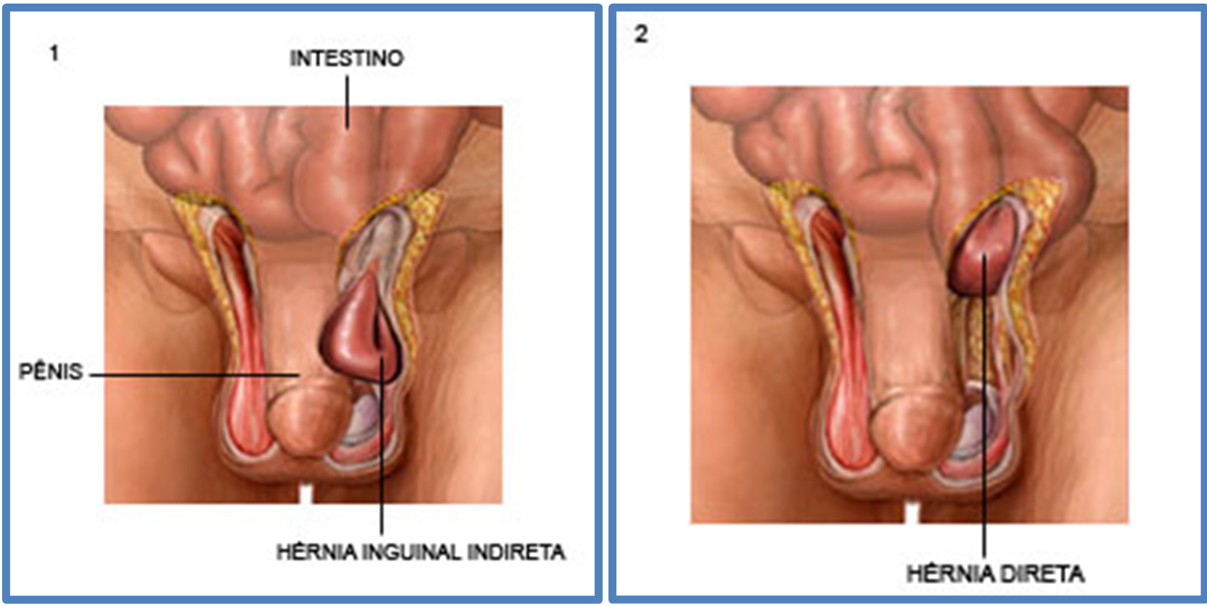 Hérnia inguinal nos praticantes de musculação - Hernia Clinic