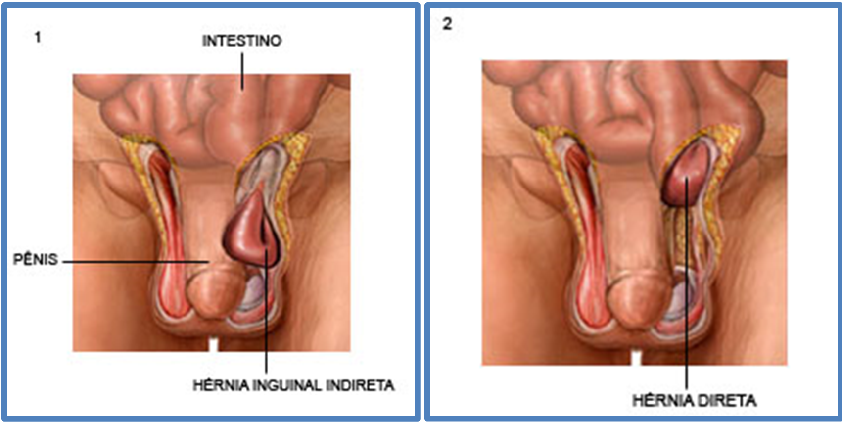 Hérnia Inguinal