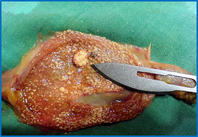 cancer biliar sintomas