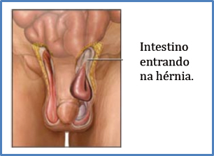 Fiz uma cirurgia de hernia inguinal, será que ainda posso jogar